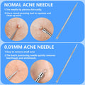 Remover Comedone Extractor Kit 5 Piece — Professional Stainless Steel Pimple & A