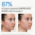 Nutrafol Clear Skin Nutraceutical Acne Supplement 3-Month Supply