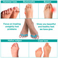 NAMELESS NICHE Toe Separators Bunion Corrector Toe Spacers White 1 Pair